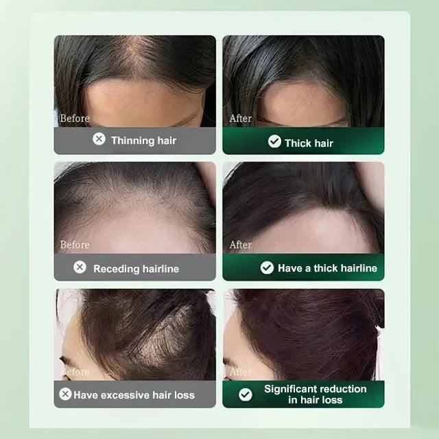 Last Day Of Discount 🔥 Anti Hair Loss & Regrowth Spray